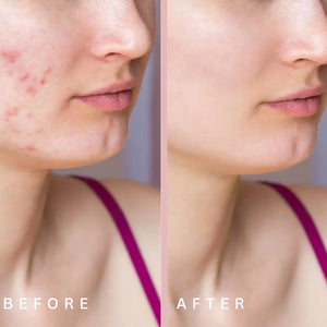 Before and After Acne treatment