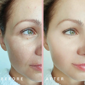 Before and After wrinkles light treatment