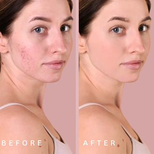 Before and After acne light therapy treatment