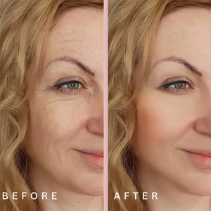 Before and after wrinkles redlight therapy treatment