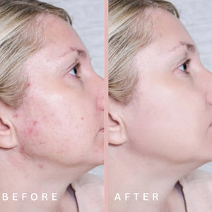 prone acne results uing bluelight therapy before and after results